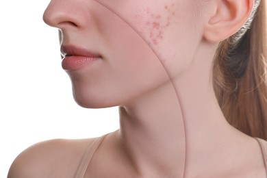 Image of Acne problem, collage. Photo of woman divided into halves before and after treatment on white background, closeup
