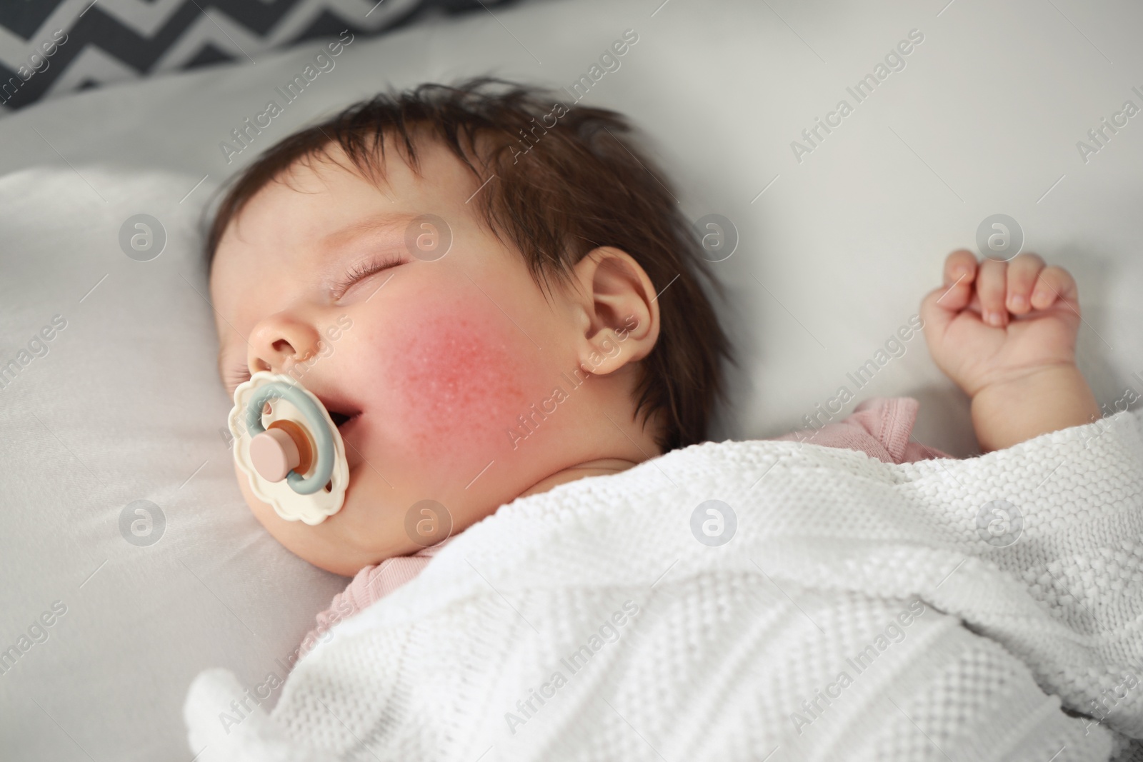 Image of Cute little baby with allergic redness sleeping on cosy bed, closeup