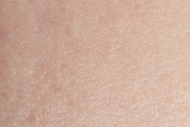 Photo of Texture of dry skin as background, macro view