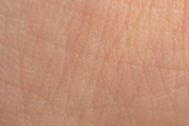 Photo of Texture of dry skin as background, macro view