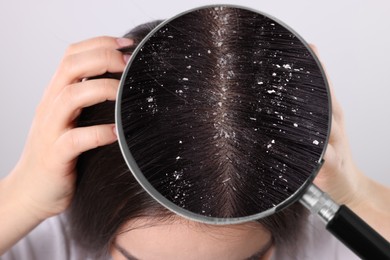 Image of Woman suffering from dandruff on light background, closeup. View through magnifying glass on hair with flakes