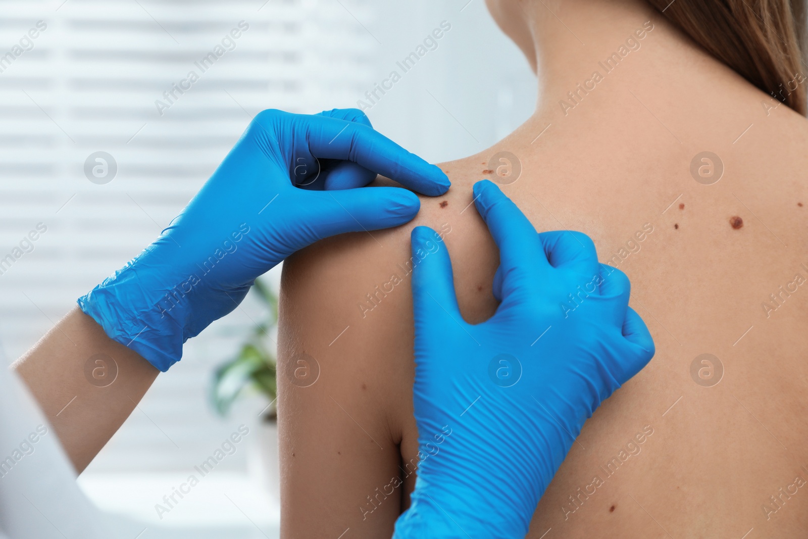 Photo of Dermatologist examining patient's birthmark in clinic, closeup view