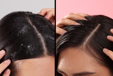 Image of Woman showing hair before and after dandruff treatment on color backgrounds, collage