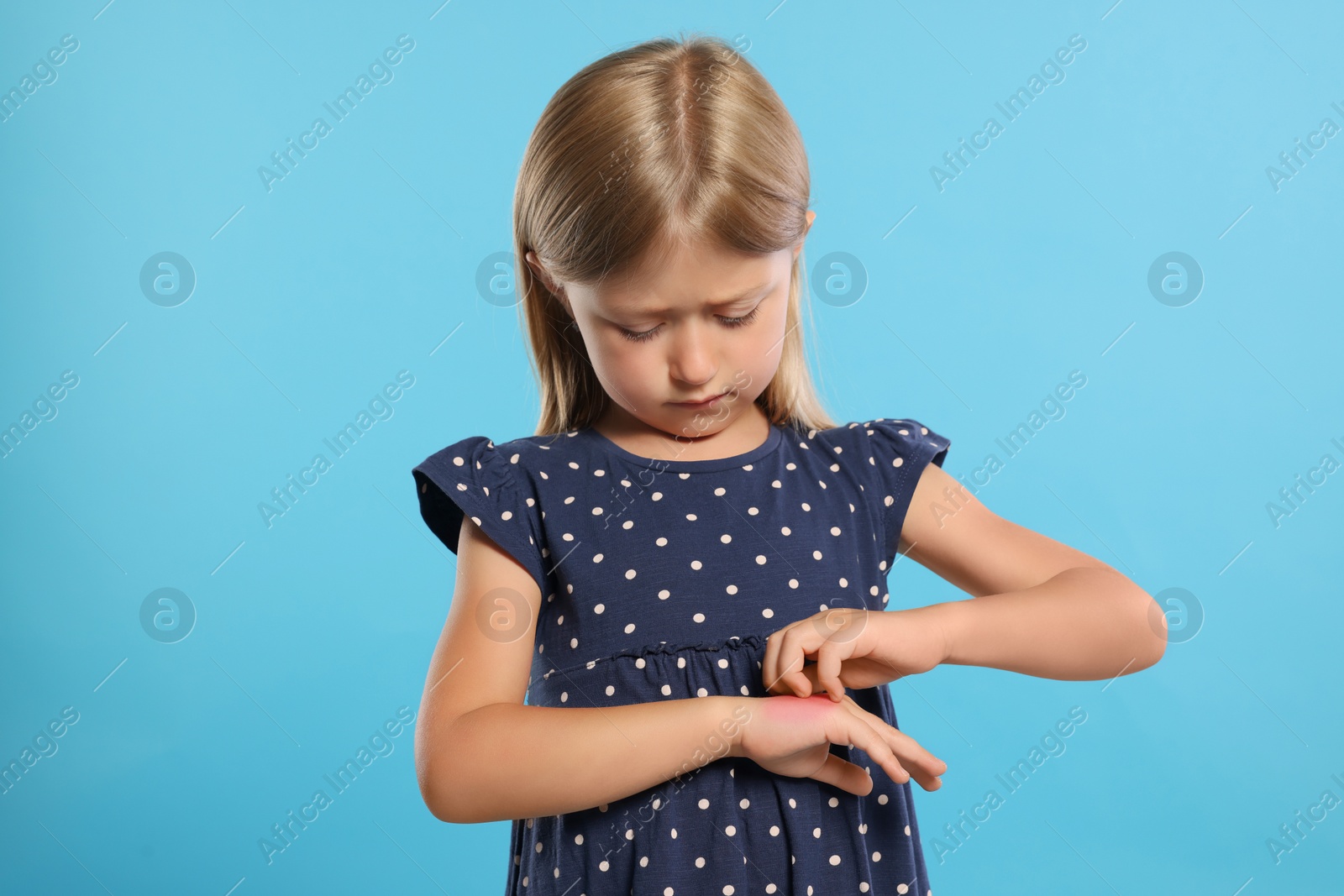 Photo of Suffering from allergy. Little girl scratching her hand on light blue background