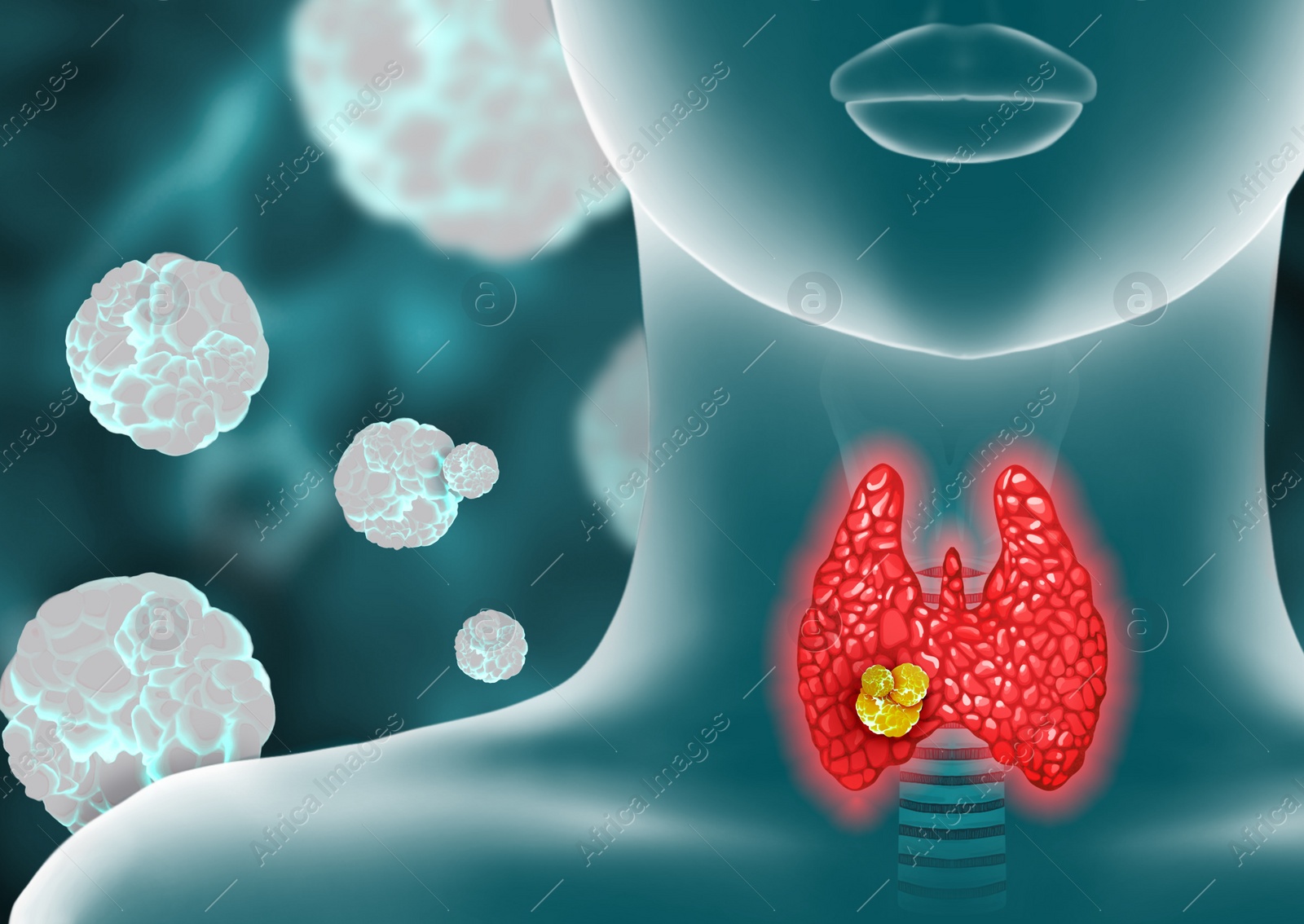 Illustration of  human thyroid cancer on color background