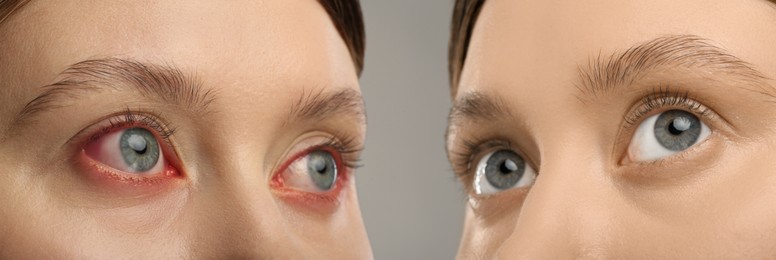 Before and after conjunctivitis treatment. Photos of woman with red and healthy eyes, collage