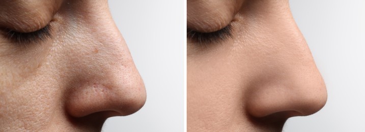 Image of Before and after acne treatment. Photos of woman on white background, closeup. Collage showing affected and healthy skin