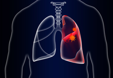Man with diseased lungs on dark background. Illustration