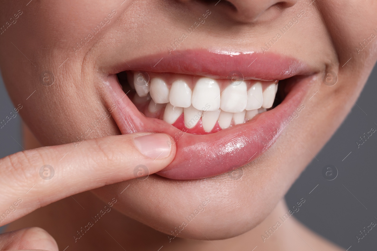 Photo of Young woman showing inflamed gums on grey background, closeup