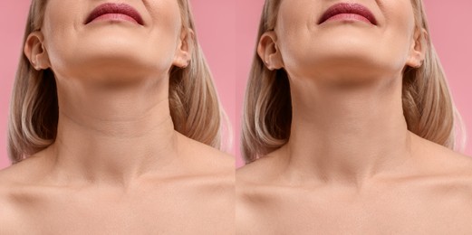 Collage with photos of woman before and after cosmetic procedure on pink background, closeup