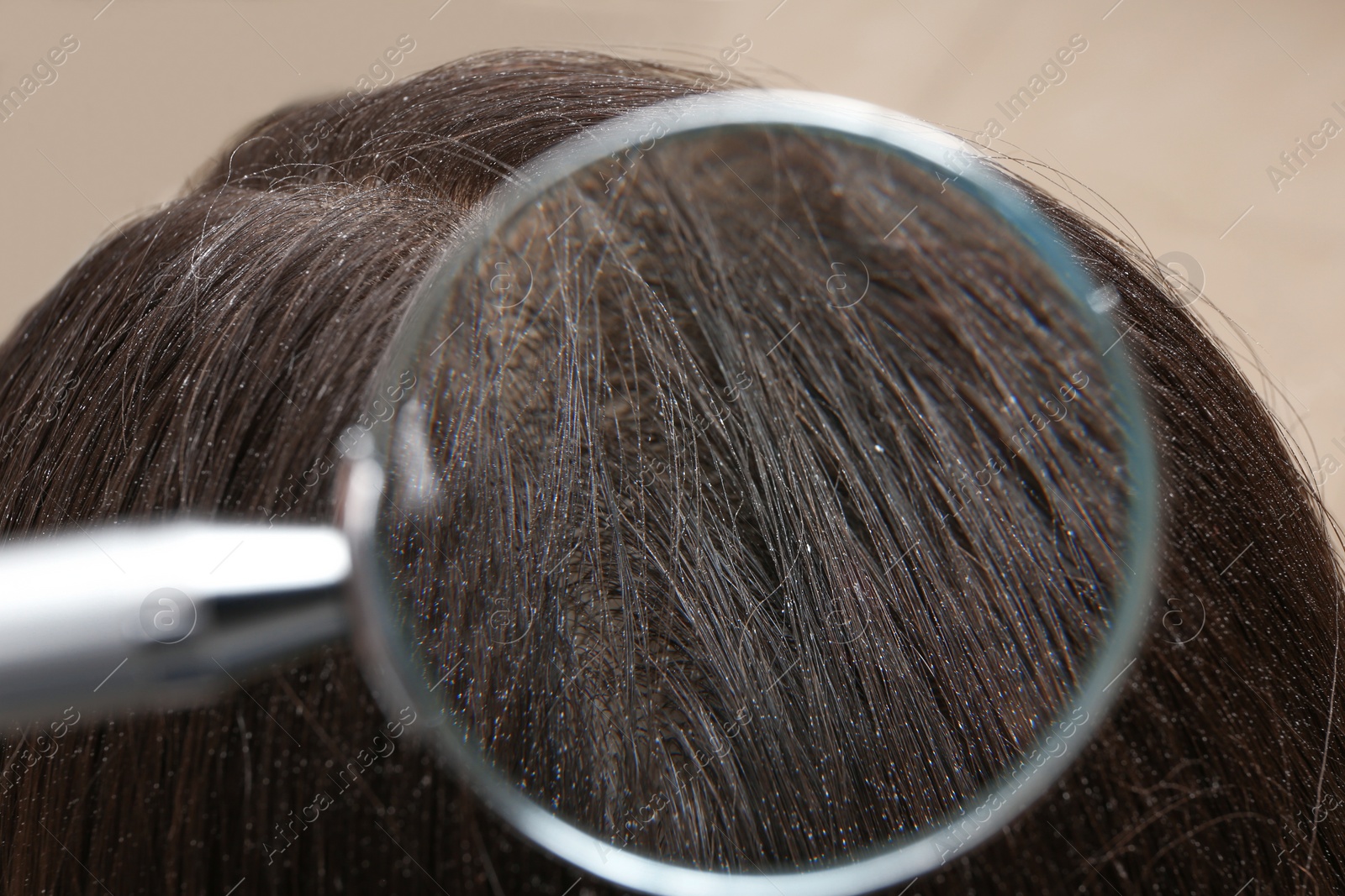 Photo of Closeup of woman with dandruff in her hair, view through magnifying glass