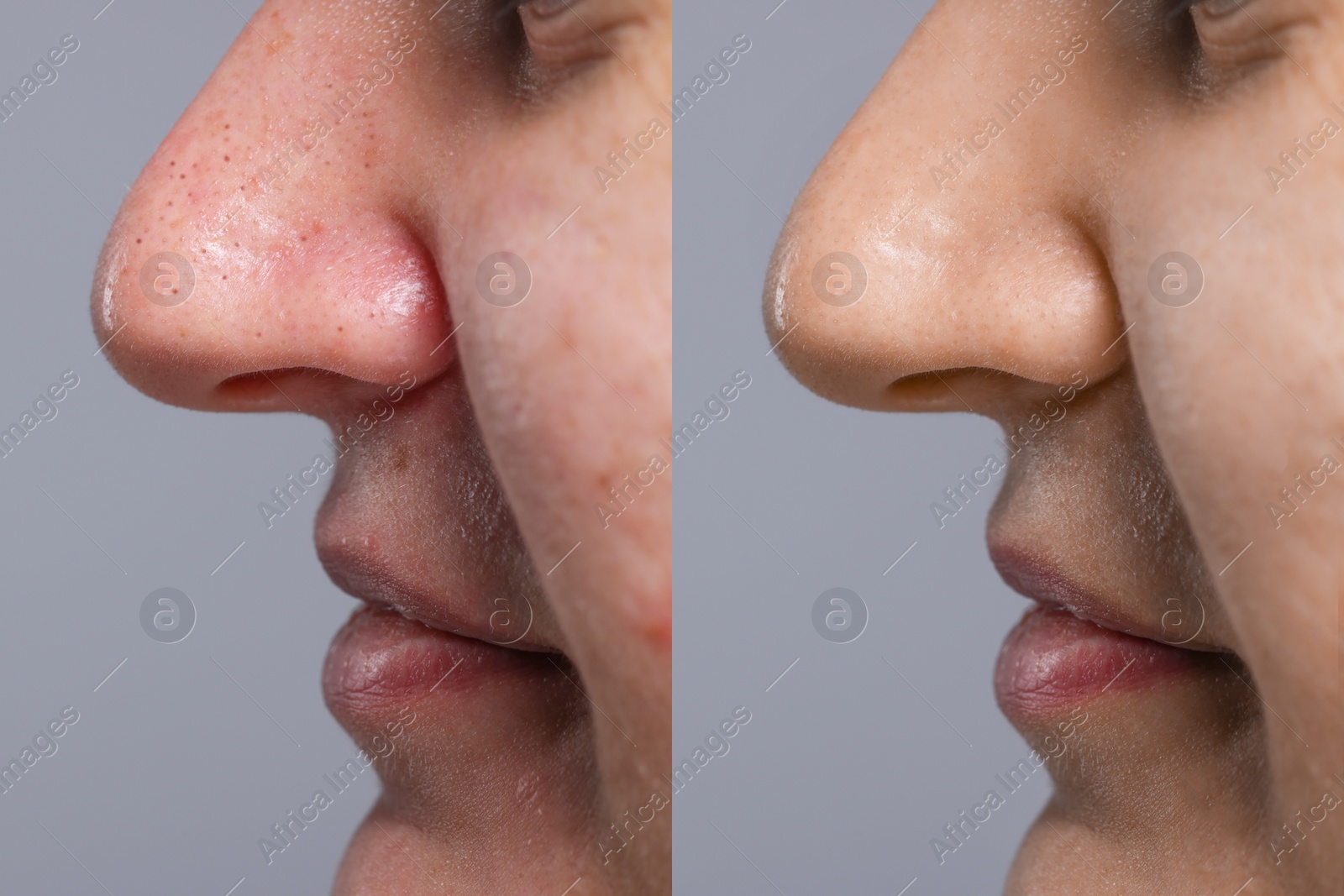 Image of Blackhead treatment, before and after. Collage with photos of woman on grey background, closeup view