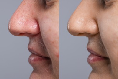 Blackhead treatment, before and after. Collage with photos of woman on grey background, closeup view