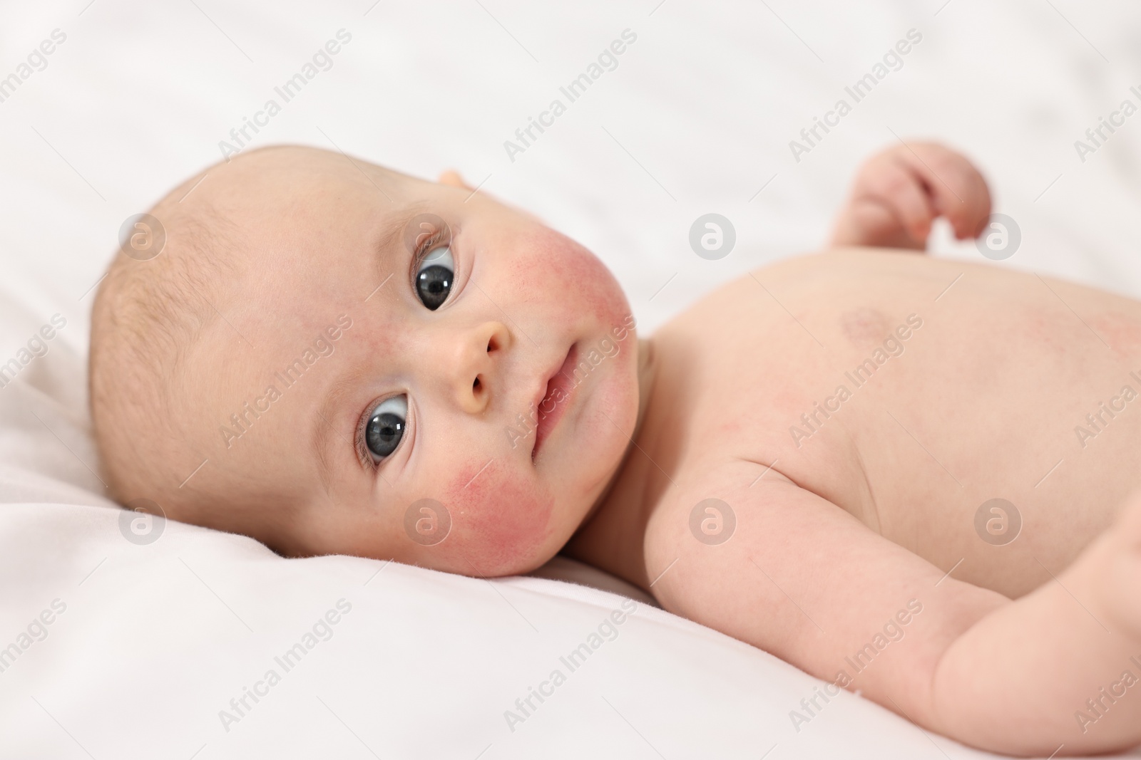 Photo of Cute little baby with allergic redness on cheeks lying on white blanket