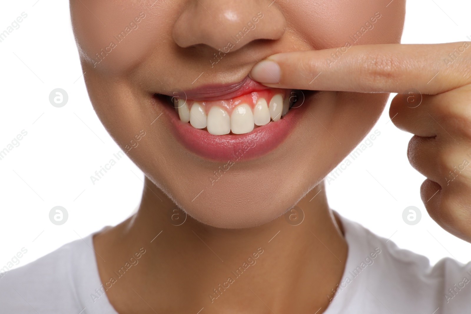 Image of Young woman showing inflamed gums, closeup view