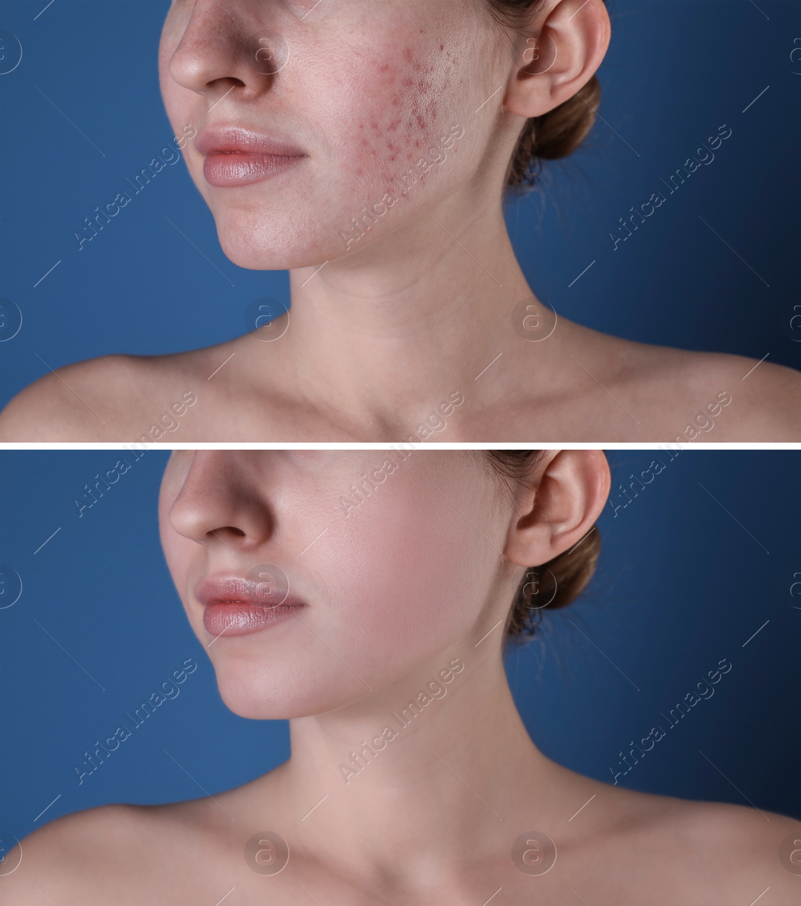 Image of Acne problem. Young woman before and after treatment on blue background, closeup. Collage of photos