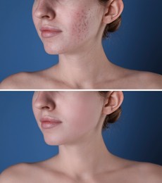 Acne problem. Young woman before and after treatment on blue background, closeup. Collage of photos
