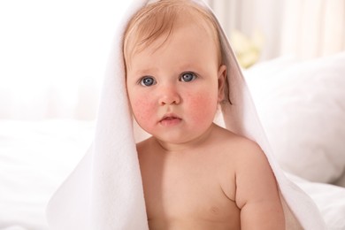 Image of Cute little baby with allergy symptoms on cheeks at home