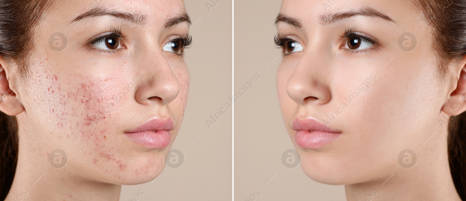 Image of Teenage girl before and after acne treatment on beige background