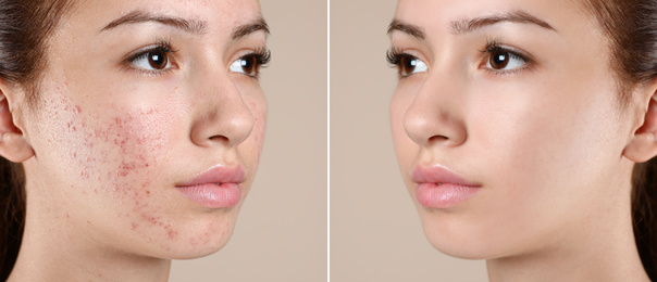 Image of Teenage girl before and after acne treatment on beige background