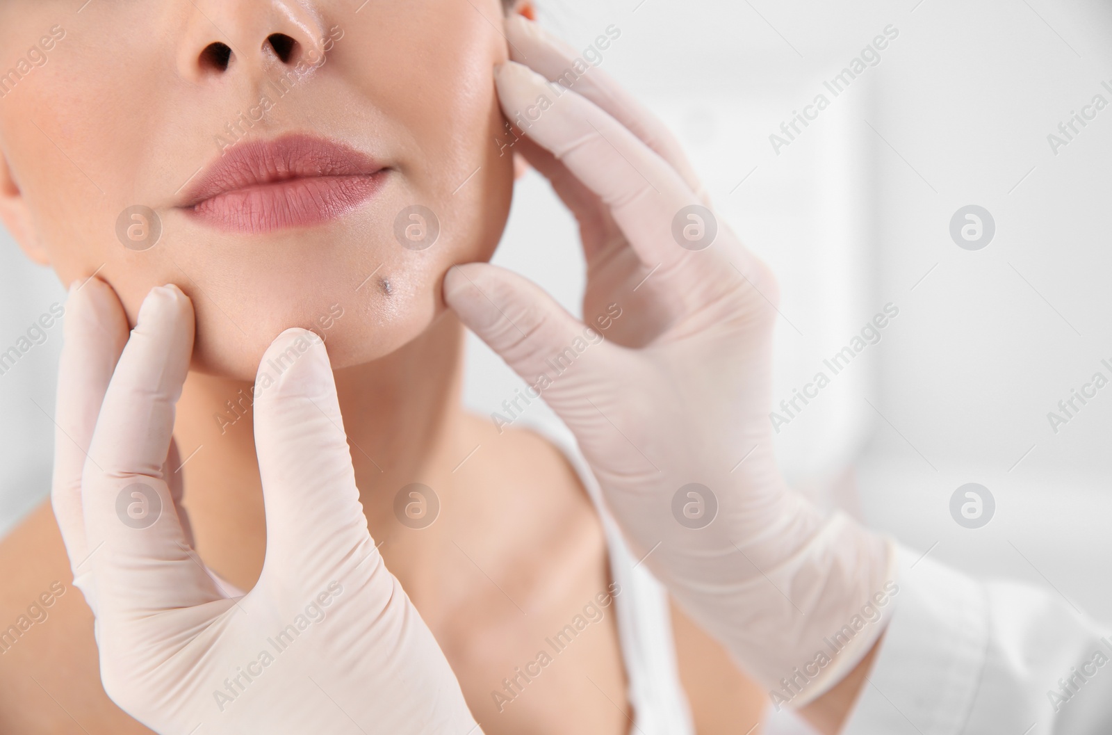 Photo of Dermatologist examining patient's birthmark in clinic, closeup