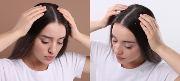 Woman showing hair before and after dandruff treatment on color backgrounds, collage