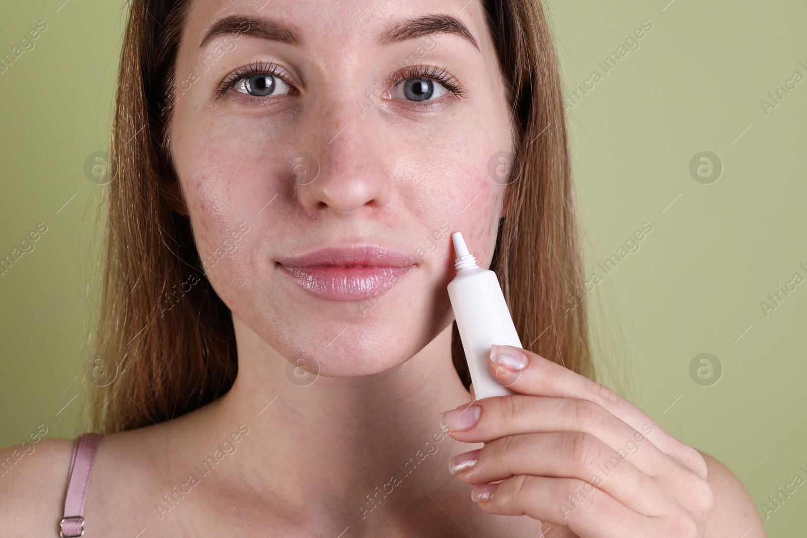 Photo of Young woman with acne problem applying cosmetic product onto her skin on olive background, closeup