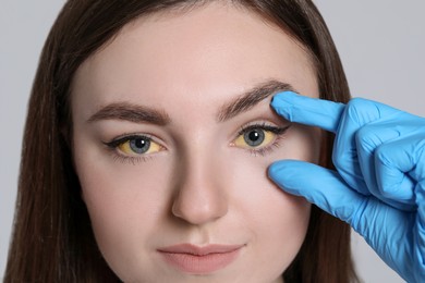 Woman checking her health condition on light grey background, closeup. Yellow eyes as symptom of hepatitis