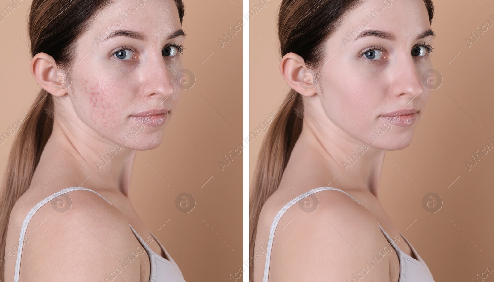 Image of Acne problem. Young woman before and after treatment on beige background, collage of photos