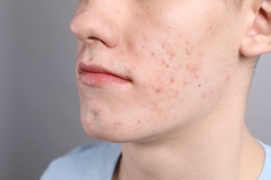 Young man with acne problem on grey background, closeup