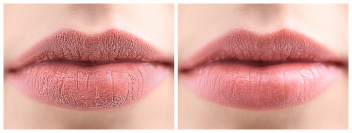 Image of Collage with photos of woman before and after using lip balm, closeup