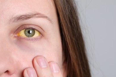 Photo of Woman with yellow eyes on light background, closeup. Symptom of hepatitis