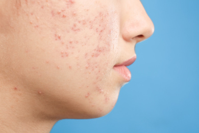 Photo of Teenage girl with acne problem on blue background, closeup