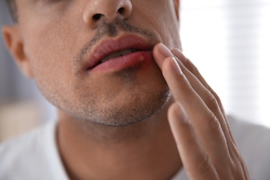 Photo of Man with herpes touching lips against blurred background, closeup