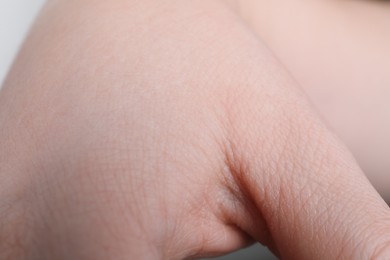 Woman with dry skin on hand, closeup