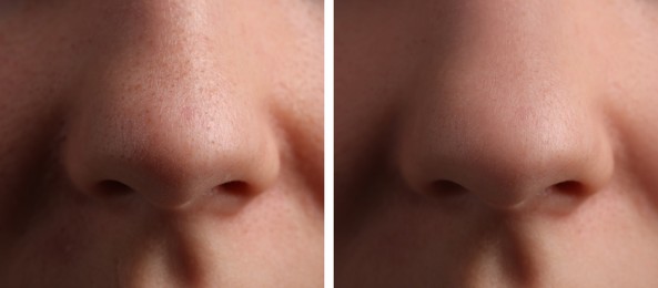 Photos of woman before and after acne treatment, closeup. Collage showing affected and healthy skin