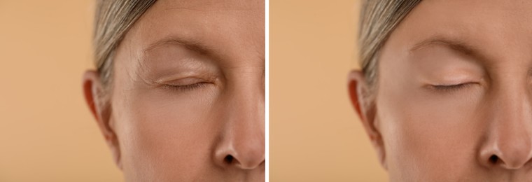Image of Aging skin changes. Woman showing face before and after rejuvenation, closeup. Collage comparing skin condition
