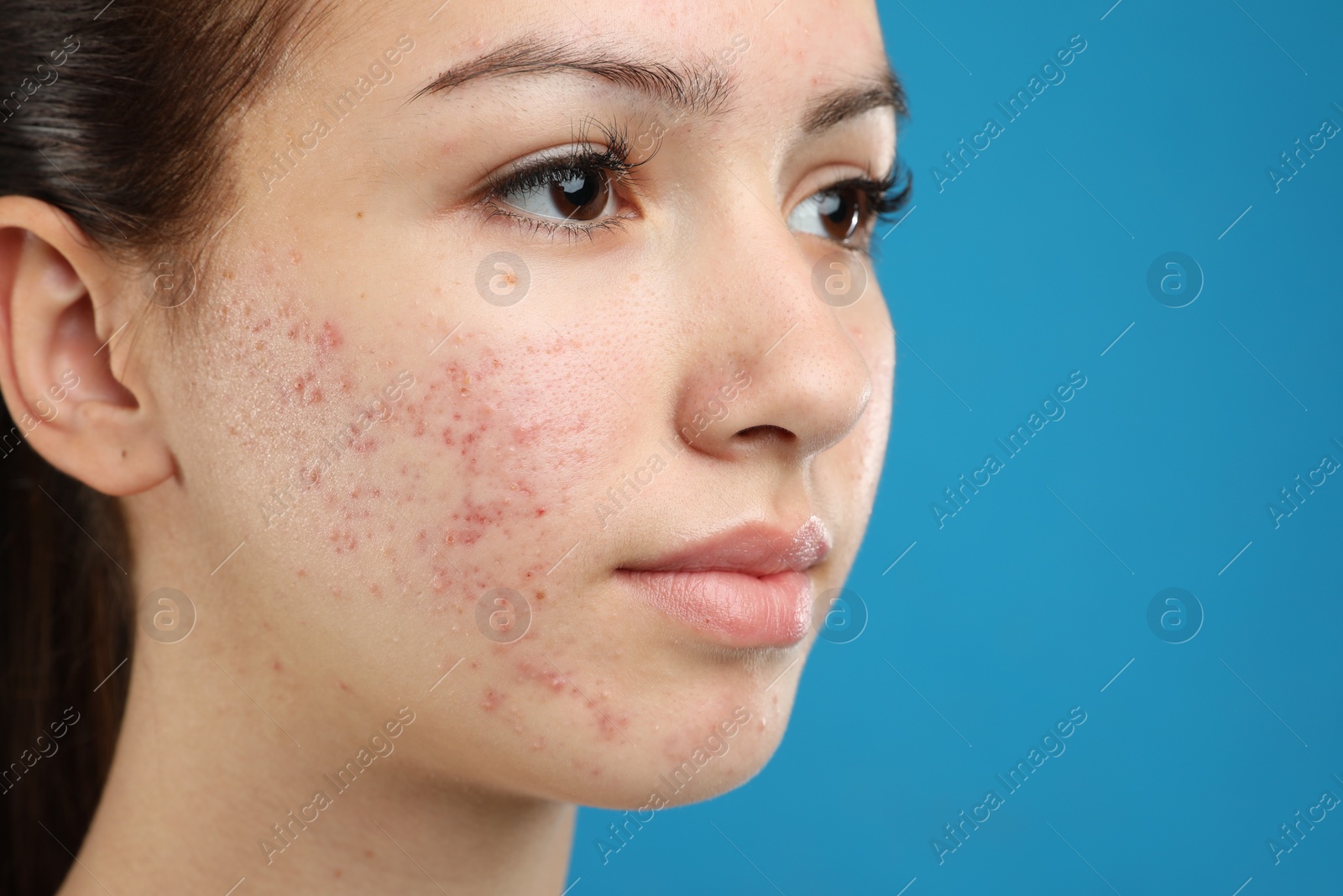 Photo of Teenage girl with acne problem on blue background, closeup