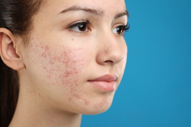 Photo of Teenage girl with acne problem on blue background, closeup