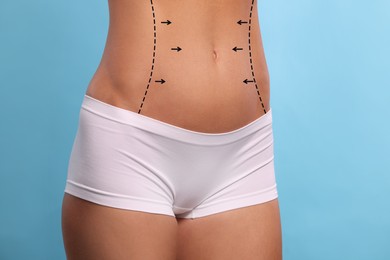 Woman with markings for cosmetic surgery on her abdomen against light blue background, closeup