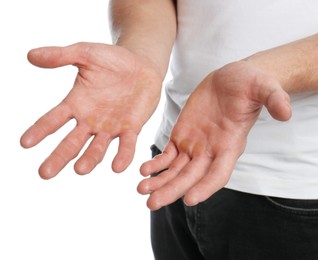 Photo of Man suffering from calluses on hands against white background, closeup