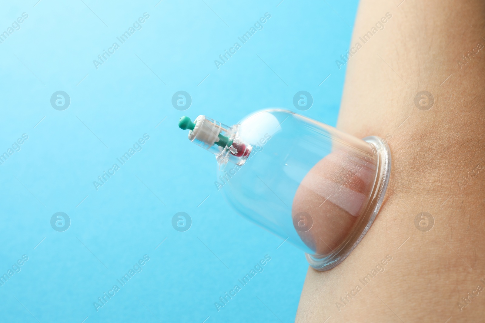 Photo of Woman with plastic cup on her body against light blue background, closeup and space for text. Cupping therapy