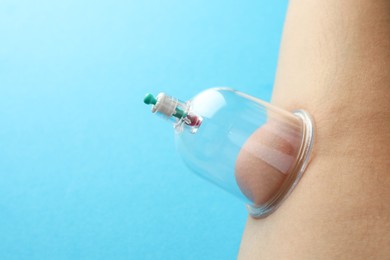 Photo of Woman with plastic cup on her body against light blue background, closeup and space for text. Cupping therapy