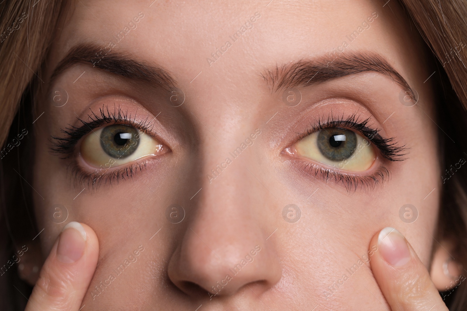Photo of Woman checking her health condition, closeup. Yellow eyes as symptom of problems with liver