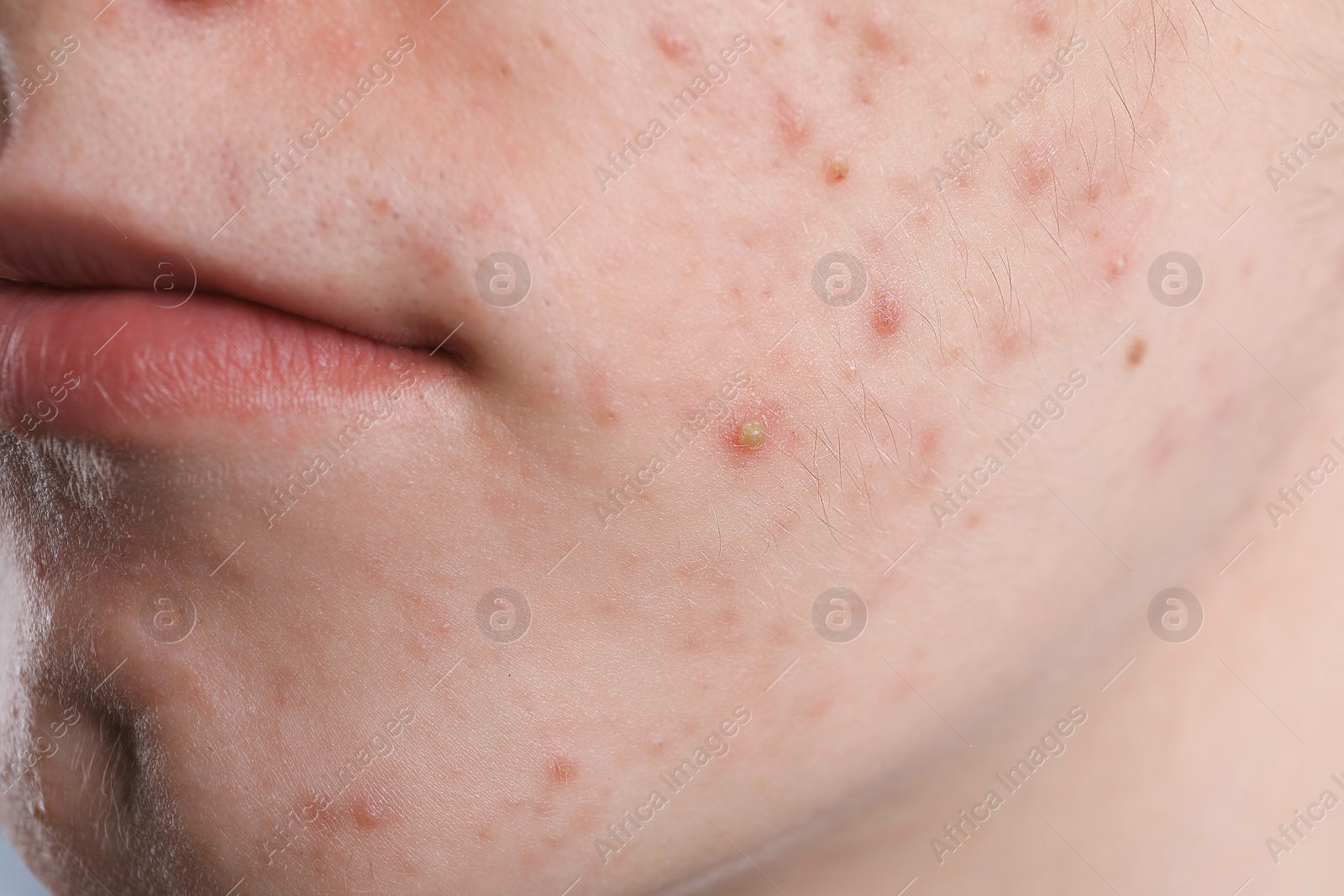 Photo of Young man with acne problem, closeup view