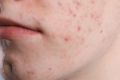 Photo of Young man with acne problem, closeup view