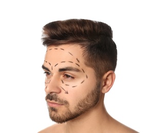Young man with marks on face for cosmetic surgery operation against white background