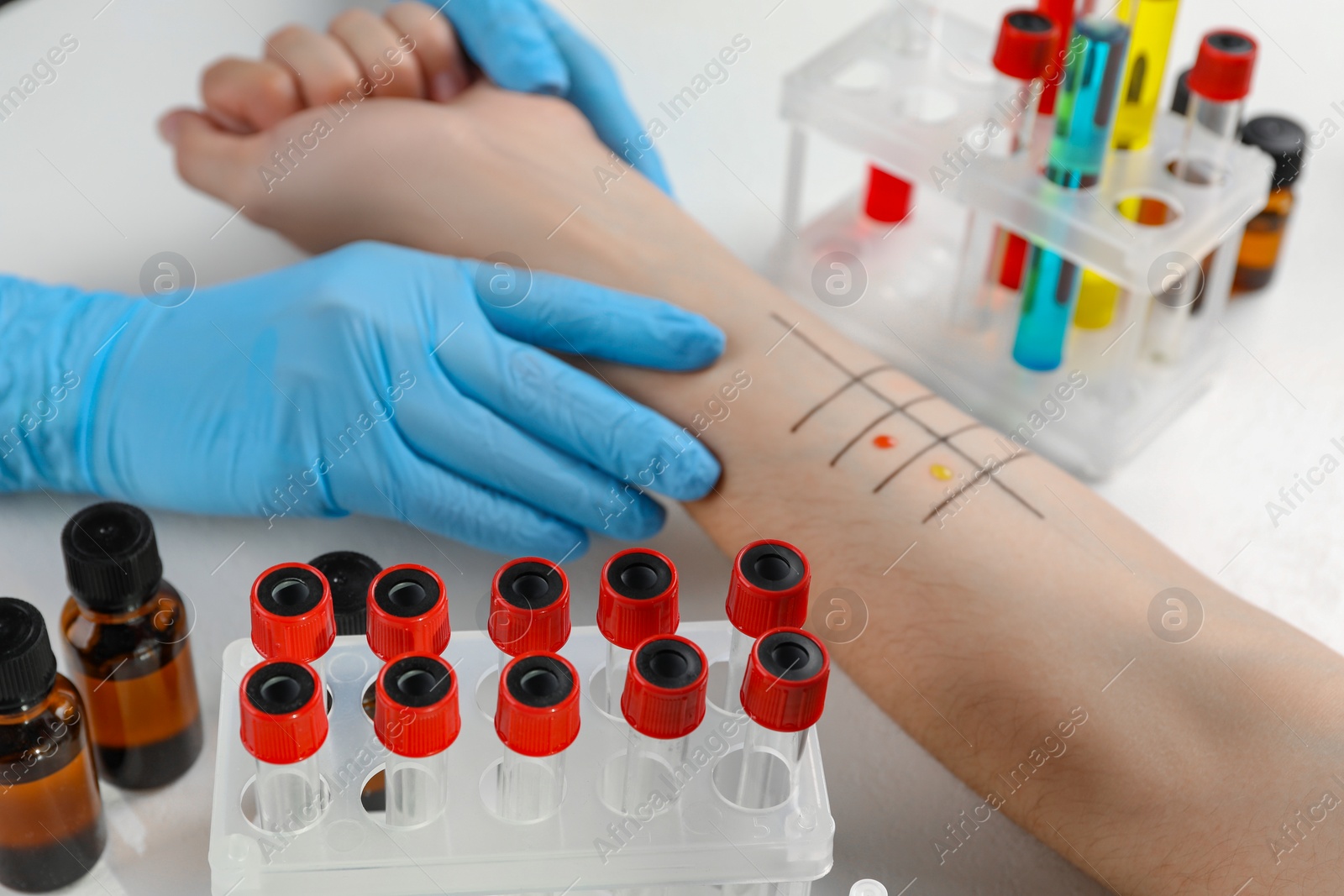 Photo of Patient undergoing skin allergy test at light table in clinic, closeup