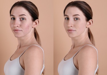 Acne problem. Young woman before and after treatment on beige background, collage of photos