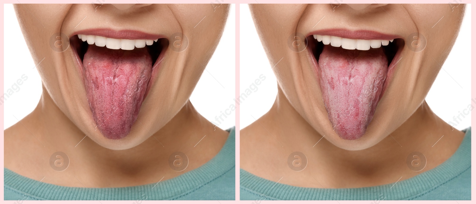 Image of Collage with photos of woman before and after tongue cleaning on white background, closeup